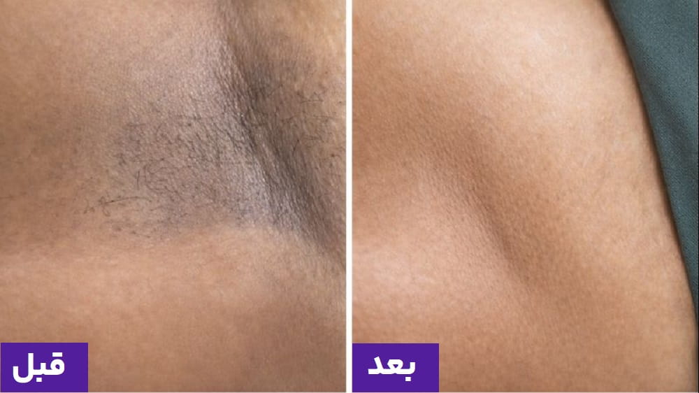 سفیدسازی واژن کاهش تیرگی پوست و بهبود ظاهر ناحیه تناسلی در کیمیا اکسیر