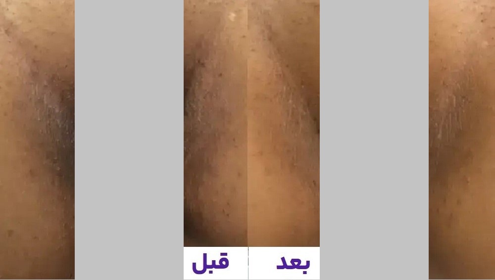 کربوکسی تراپی واژن بهبود تیرگی و افزایش شادابی پوست ناحیه تناسلی در کیمیا اکسیر