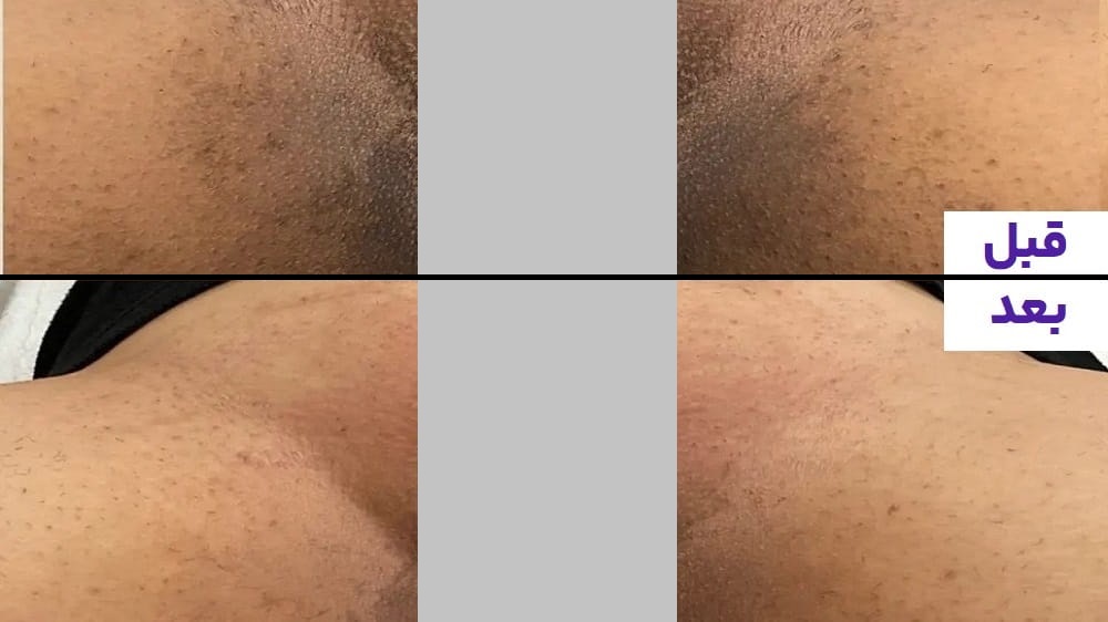 کربوکسی تراپی واژن کمک به بازسازی پوست و افزایش طراوت ناحیه تناسلی در کیمیا اکسیر